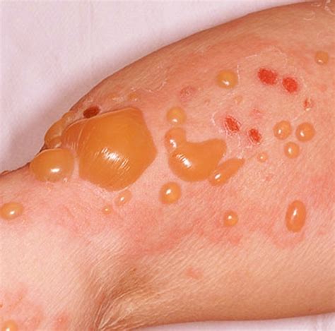 Bullous Pemphigoid: Symptoms, Causes and Treatments | MD-Health.com