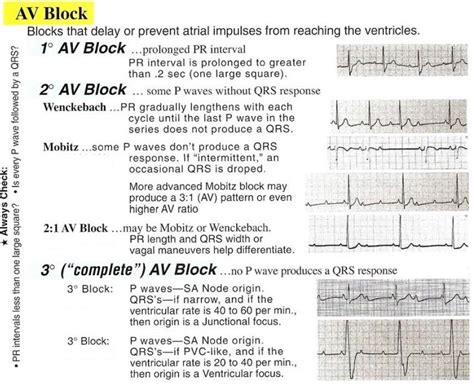 Different Types Of Heart Blocks