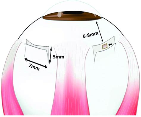 Schematic of sclerotomy procedure. A square bracket-shaped (5 Â 7-mm ...