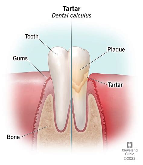 Tartar on Teeth (Dental Calculus): Causes & Removal