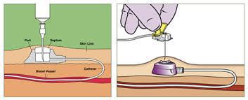 What is a port? - Care+Wear