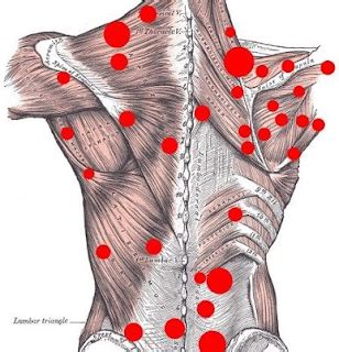 Pain Sensation: Myofascial Pain Syndrome