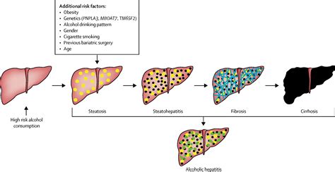 Outpatient Management Of Alcohol Related Liver Disease The Lancet ...