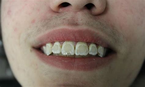 Teeth Whitening Temple TX | White Spots On Teeth After Braces