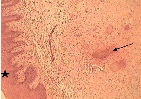 Photomicrograph showing mineralization in the form of cementum like... | Download Scientific Diagram