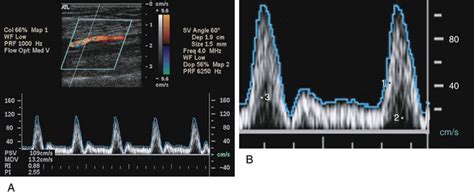 Basic Concepts of Doppler Frequency Spectrum Analysis and Ultrasound Blood Flow Imaging ...