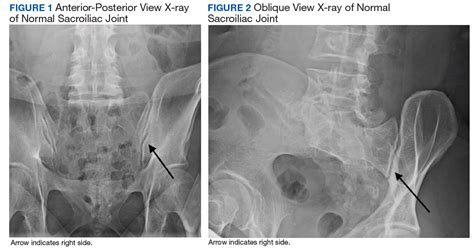 Sacroiliac Joint Dysfunction X Ray