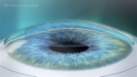 Photorefractive Keratectomy (PRK) Laser Eye Surgery - YouTube