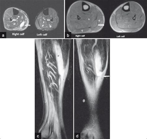 Plantaris Muscle Mri