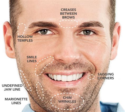 Dermal Fillers for Men: Softening & Correcting in Midtown Toronto | Midtown Med Spa Services ...