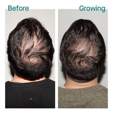 nutrafol-men-before-after-pics | Reactive Hair