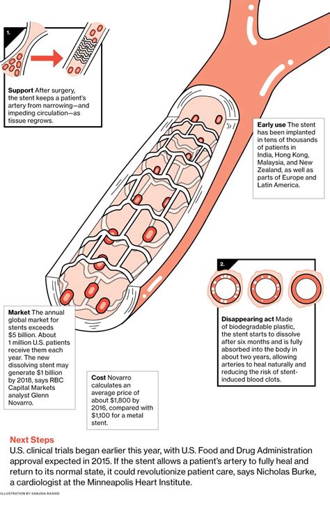 Heart Innovation: Abbott Labs' Dissolving Heart Stent Helps Improve ...