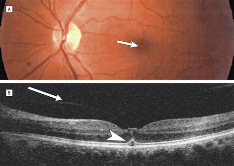 Stage 1 Macular Hole as a Complication of Laser Iridotomy ...