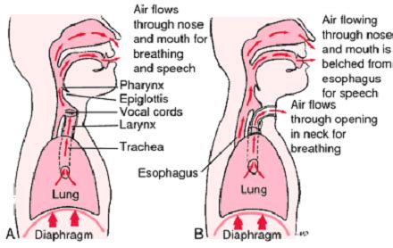 Medical Treatment Pictures-for Better Understanding: Total Laryngectomy ...