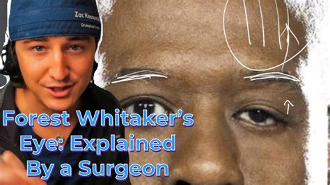 Forest Whitaker’s Eye- Explained by an Eyelid Surgeon | Understanding Ptosis - YouTube