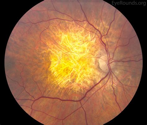 Age-related macular degeneration