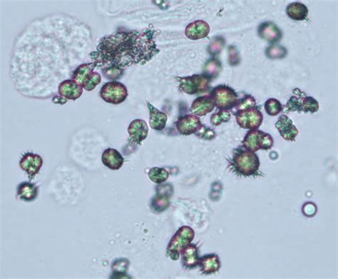 Types of Crystals in Urine