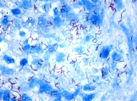 Tuberculous bacilli (acid-fast bacilli) present in large quantities ...