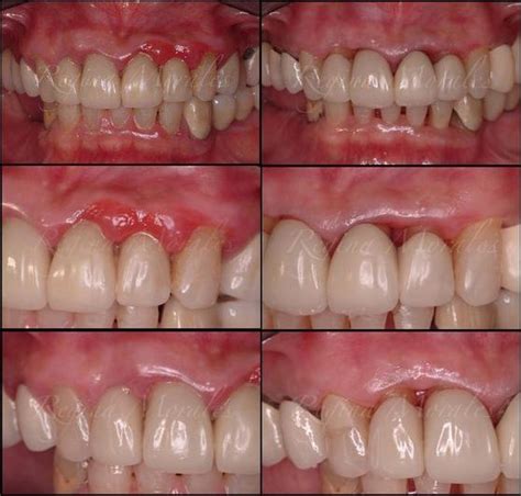 Laser Gum Surgery Before And After