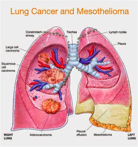 Medical Treatment Pictures-for Better Understanding: Malignant ...