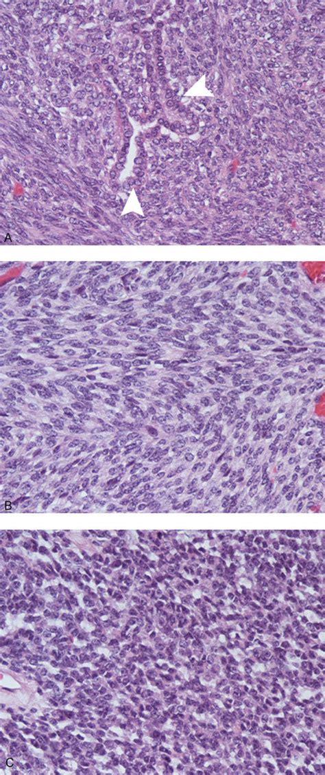 Histology of synovial sarcoma. Top: biphasic synovial sarcoma ...