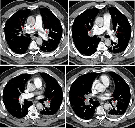 Saddle pulmonary embolism – Radiology Cases