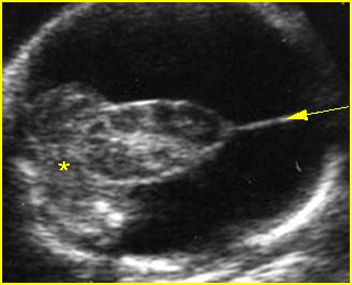 Hydranencephaly – Department of Obstetrics and Gynecology Faculty of ...