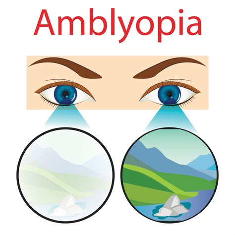 Strabismus and Amblyopia - Azar Eye Clinic