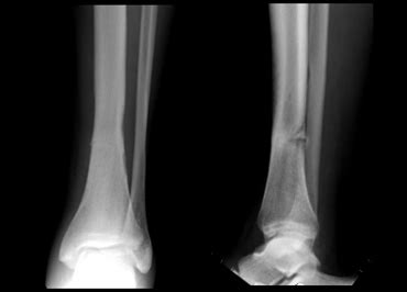 Stress Fracture Fibula X Ray