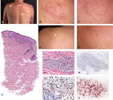 Clinicopathologic features of early lesions of primary cutaneous ...