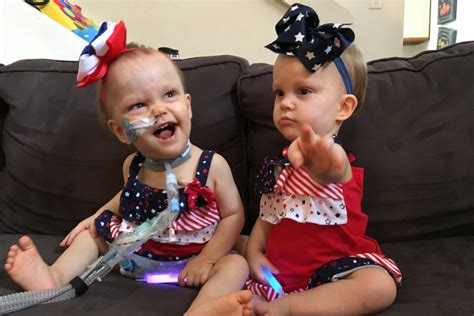 Siamese twins separated after 7-hr surgery - see how they look today