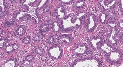 Flat epithelial atypia of the breast | Ottawa Atlas of Pathology