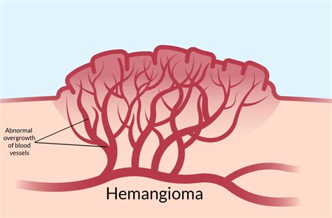 What Is a Vascular Birthmark? | Calgary