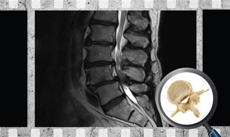 Relationship Between MRI Findings and Clinical Symptoms in Lumbar Spinal Canal Stenosis