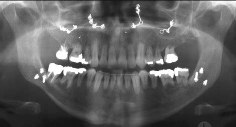 Orthodontic Root Resorption | Pocket Dentistry