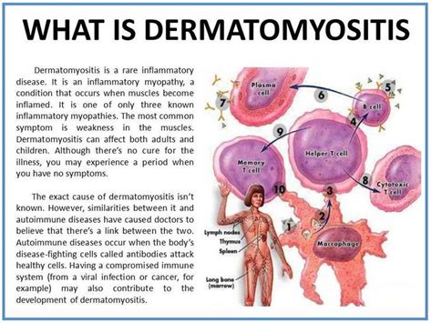 Pin on Dermato- myositis