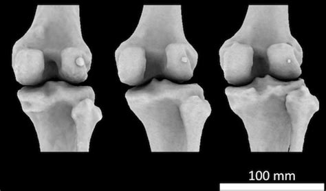 Fabella: the knee bone that's making a comeback – and could be a real pain