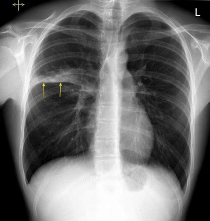 Right upper lobe consolidation – CXR - Radiology at St. Vincent's University Hospital