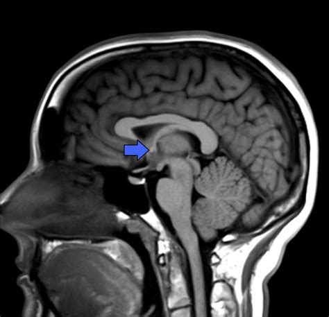 Mammillary Bodies Mri