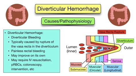 Diverticular Disease: Diverticulitis vs Diverticulosis - Symptoms, Diet, Causes, Treatment, Pain ...