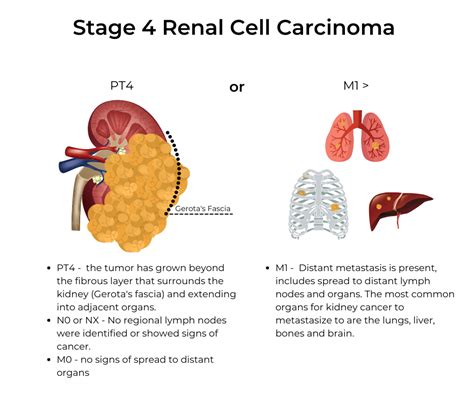 Renal Cell Carcinoma Staging