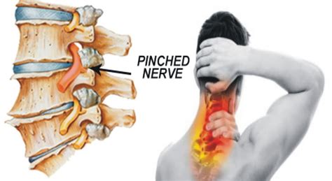 Cervical Radiculopathy Pinched Nerve In Neck Symptoms Treatment | The ...