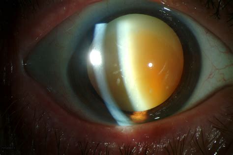 Morgagnian Cataract. EyeRounds.org - Ophthalmology - The University of Iowa