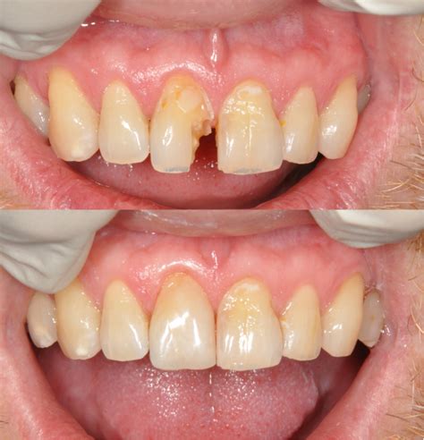 Before and After 5 | Burpengary Dental