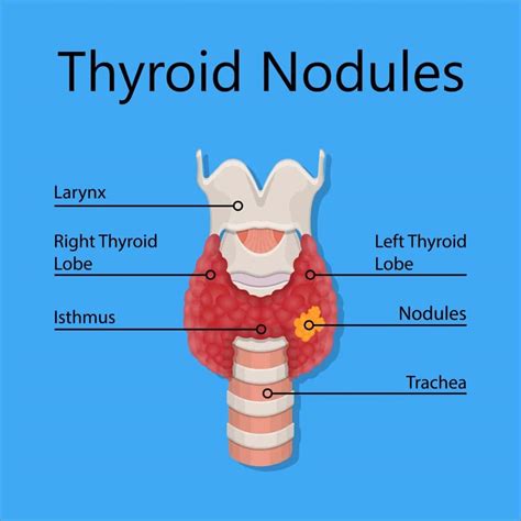 Thyroid Nodules: Key Points You Should Know