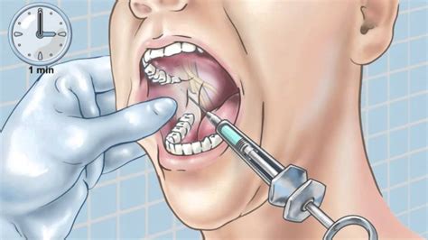 inferior alveolar nerve block Archives - Dental Clinic