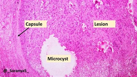 Pathology of Schwannoma - Pathology Made Simple