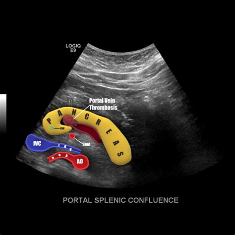 Splenic Vein Ultrasound