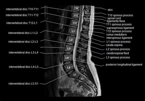 MRI spine anatomy | free MRI lumbar spine sagittal cross sectional anatomy | Mri, Anatomy images ...