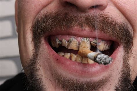 What Tobacco Does to Your Oral Health - West Palm Beach Dentist